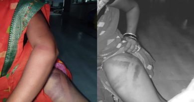 मारहाणीमुळे शरीरावर आलेल्या जखमांचे व्रण दाखवणारा पीडित महिलेचा फोटो